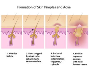 acne-illustration