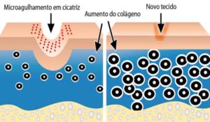 microagulhamento-info